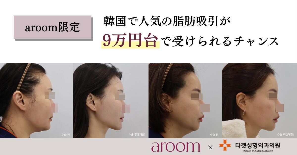 韓国人気クリニックの脂肪吸引が今だけ9万円台のお得なキャンペーン