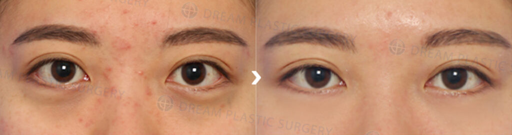 ドリーム整形外科 目の下脂肪再配置症例