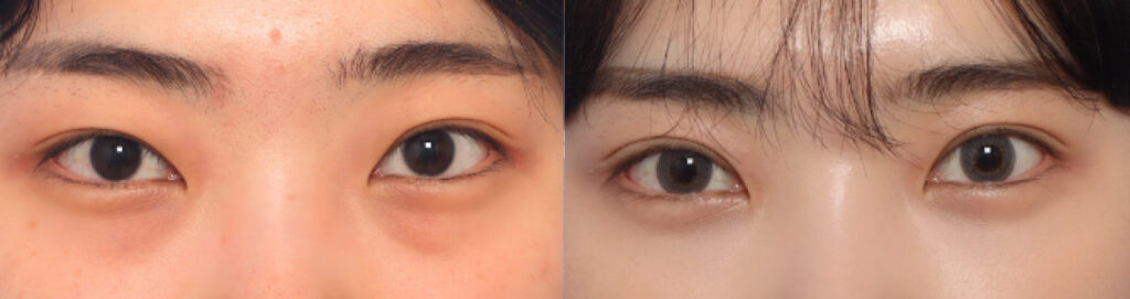 ドリーム整形外科 目の下脂肪再配置症例