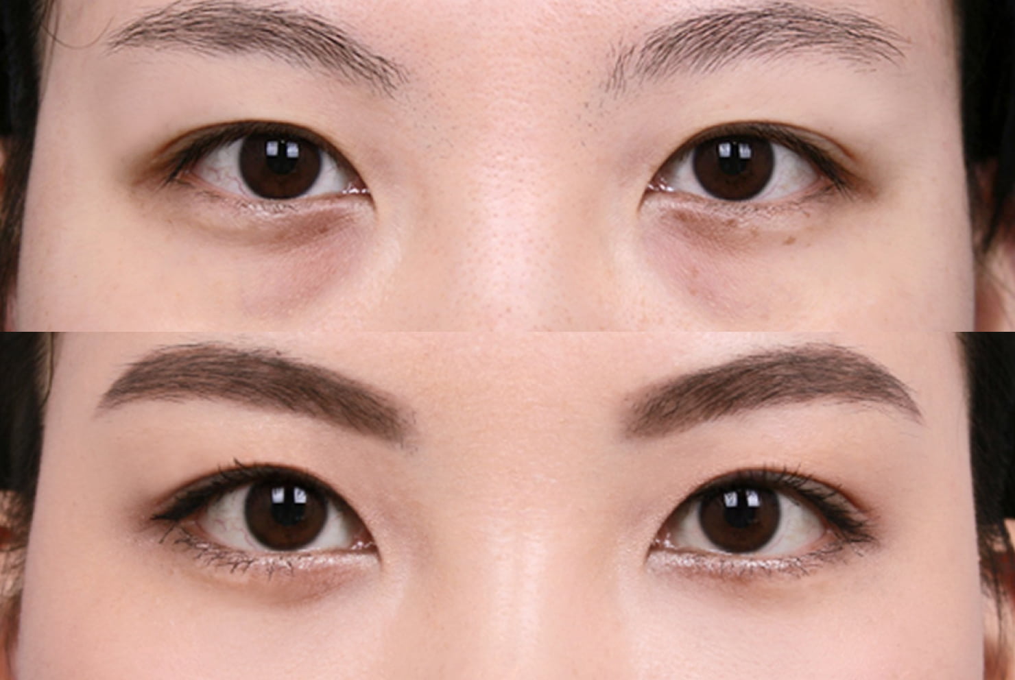 ラミチェ美容外科の症例写真（目の下脂肪再配置）