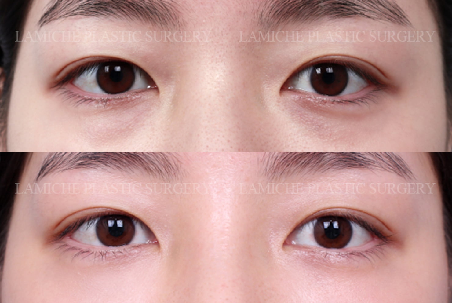 ラミチェ美容外科の症例写真（目の下脂肪再配置）