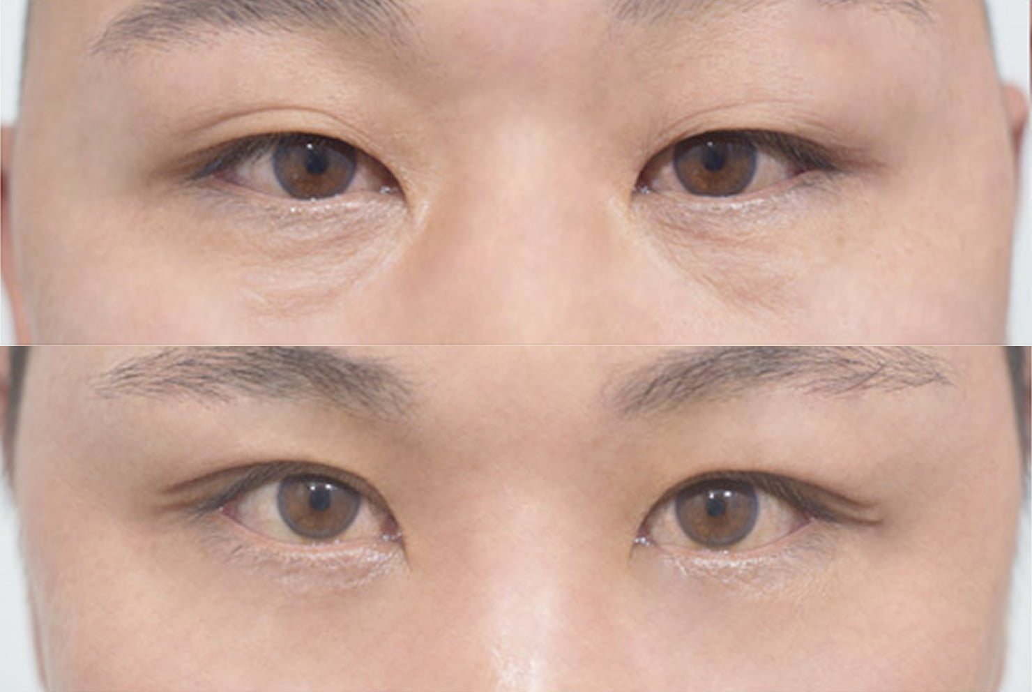 ラビアン整形外科の症例写真（目の下脂肪再配置）