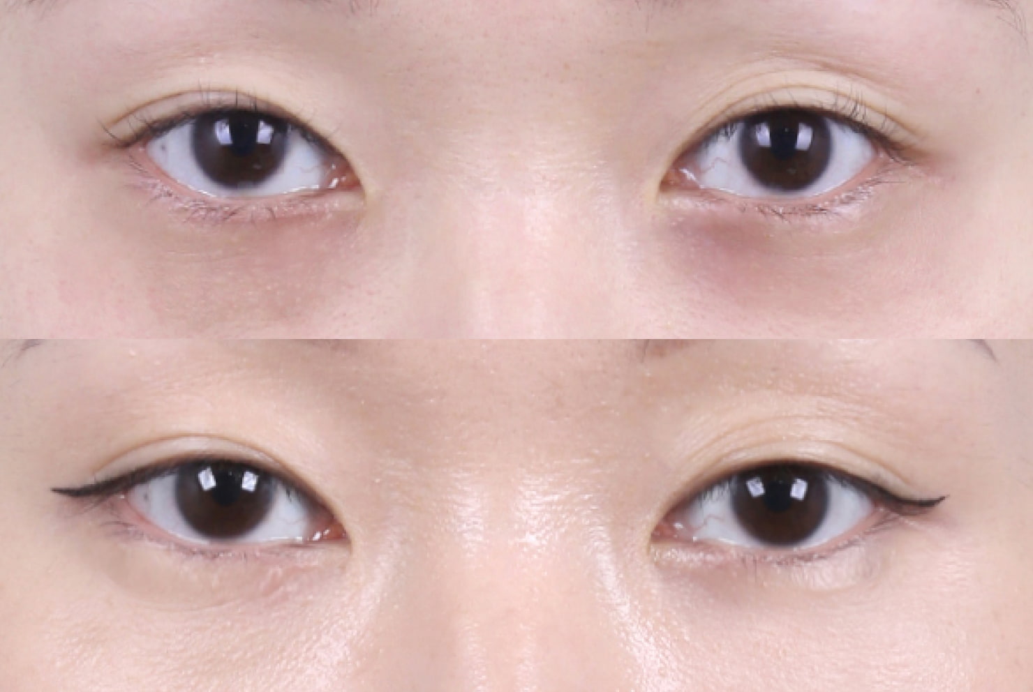 リエンジャン美容外科の症例写真（目の下脂肪再配置）