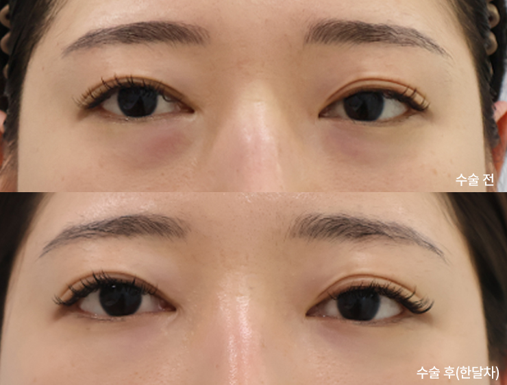 ターゲット整形外科の症例写真（目の下脂肪再配置）