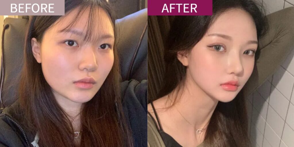 リエンジャン症例01
