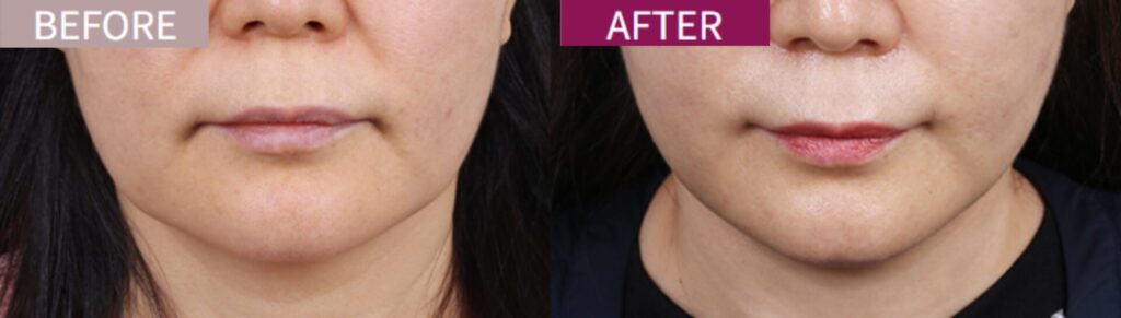 リエンジャン症例03