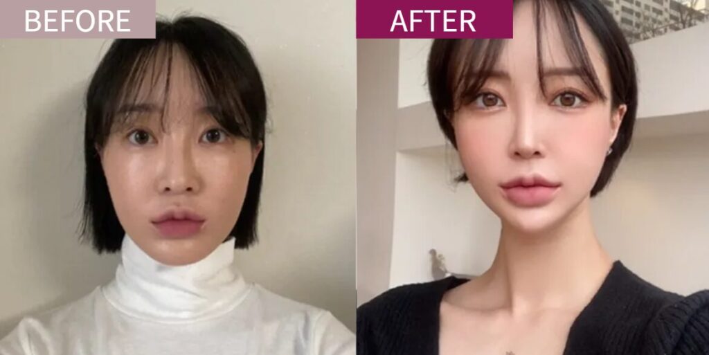 リエンジャン症例02
